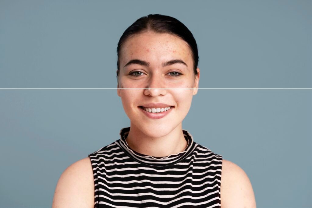 Acne and Blemish Control