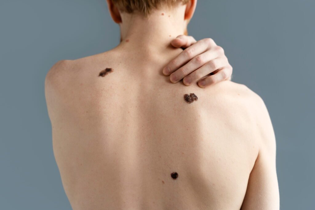 Back Acne Treatment